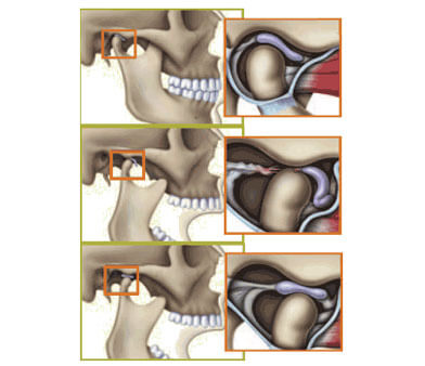 ‘Clicky’ or clicking jaw (TMJ)